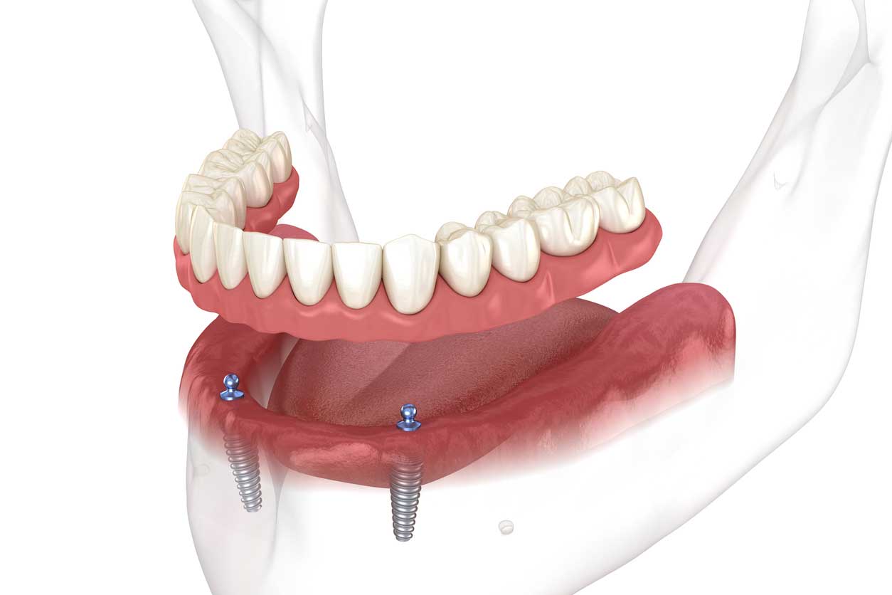 Implant-Supported Dentures in DeFuniak Springs, FL at Smile Again Florida