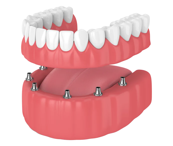Implant-Supported Dentures