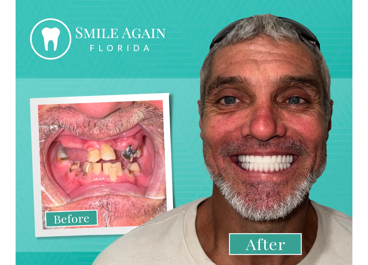 smile-again-web-before-after-unamed2